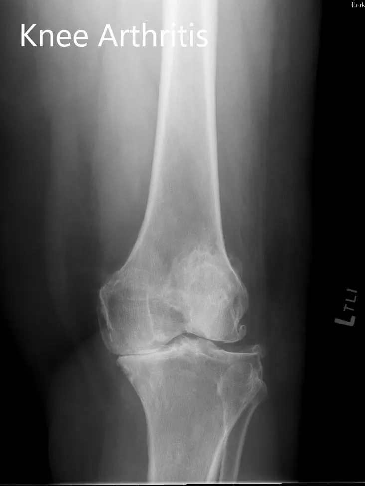 Preoperative X-ray showing the lateral and the AP views - img 2