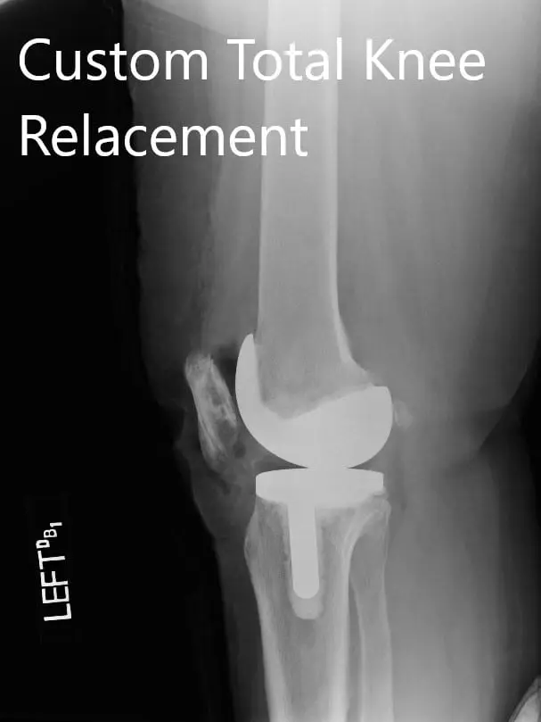 Postoperative X-ray images showing the AP and lateral views of the left knee - img 2
