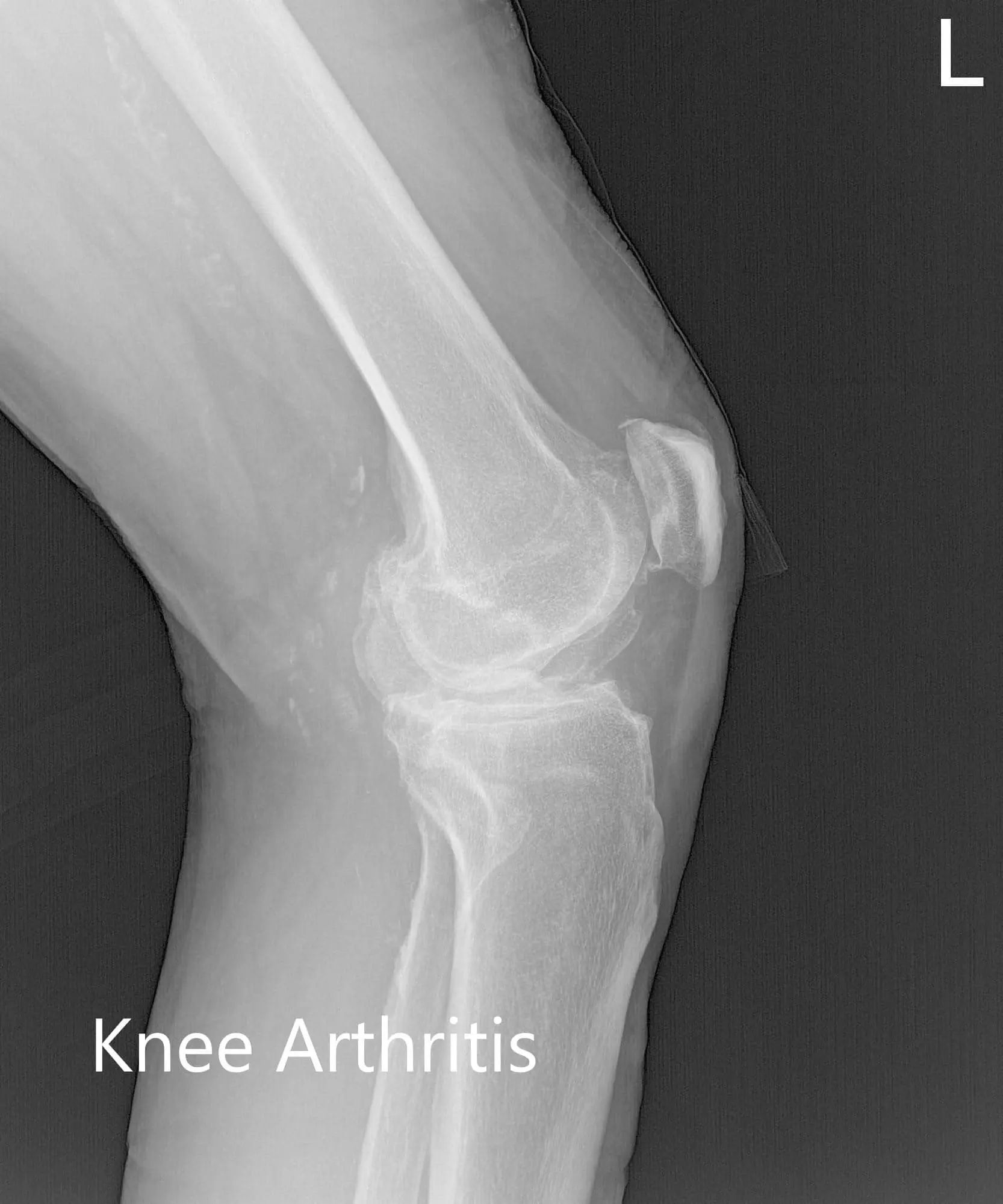 Preoperative X-ray of the left knee showing AP, lateral and merchant views - img 2