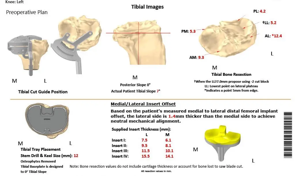 Complete Orthopedics patient specific surgical plan for a Custom Left Knee Total Replacement in a 68-year-old Female
