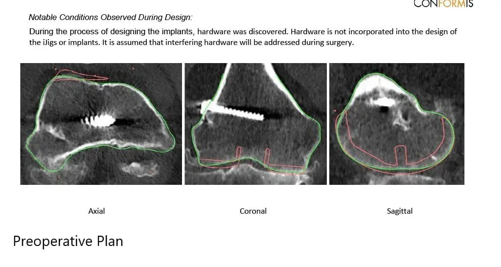 Preoperative X-ray showing the AP and lateral views of the right knee with retained screws consistent with ACL reconstruction - img 3