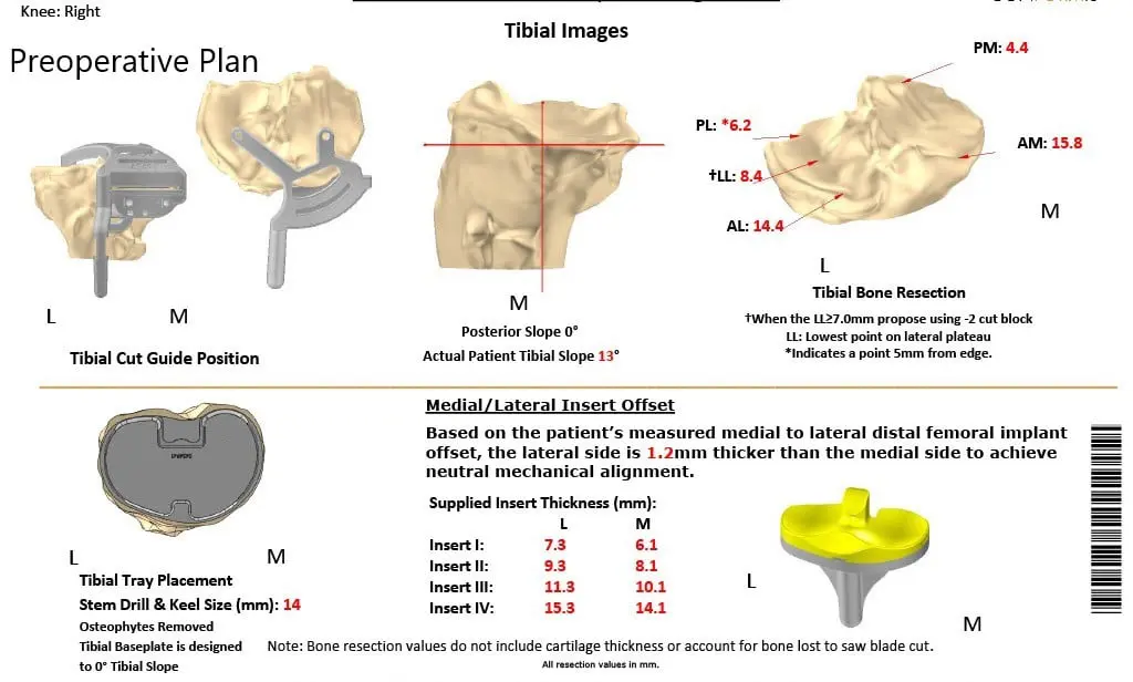 Complete Orthopedics patient specific surgical plan for a Custom Right Total Knee Replacement in a 55-year-old Female with Prior ACL Reconstruction