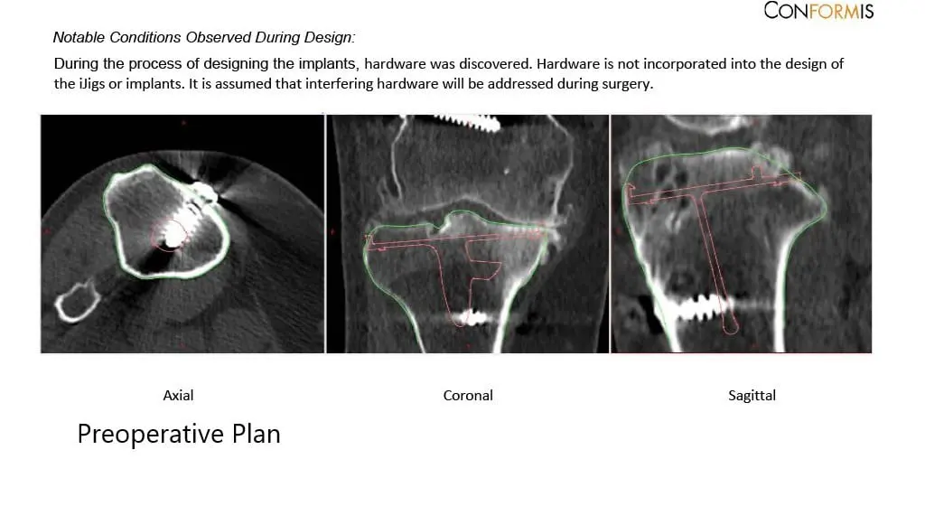 Preoperative X-ray showing the AP and lateral views of the right knee with retained screws consistent with ACL reconstruction - img 3