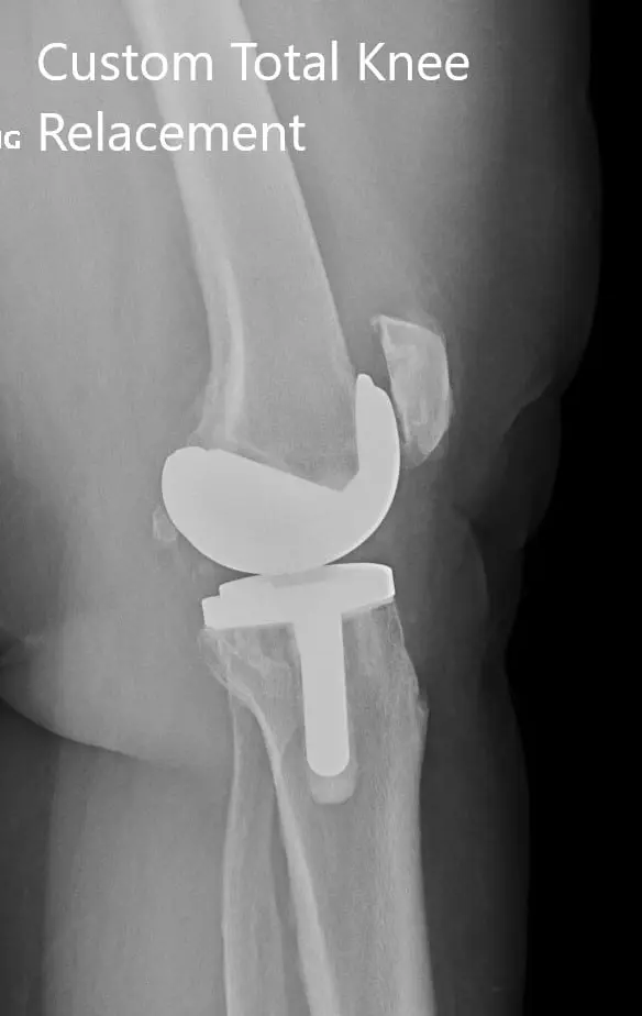 Postoperative X-ray showing the lateral views of both knees 