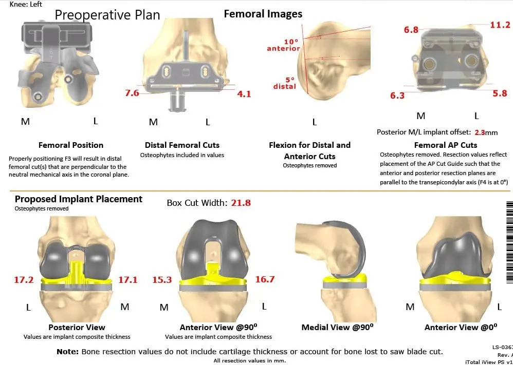 Complete Orthopedics patient specific surgical plan for a Customized Left Knee Total Replacement in a 66-year-old female - scan 2