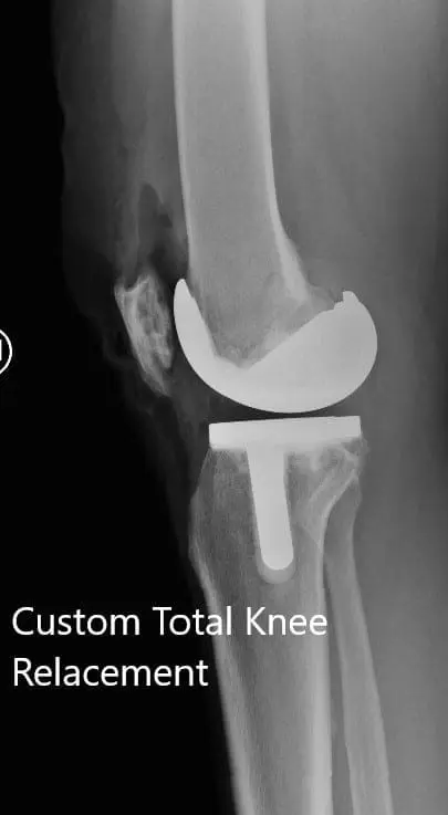 Postoperative X-ray showing the AP and lateral views of the left knee - img 2