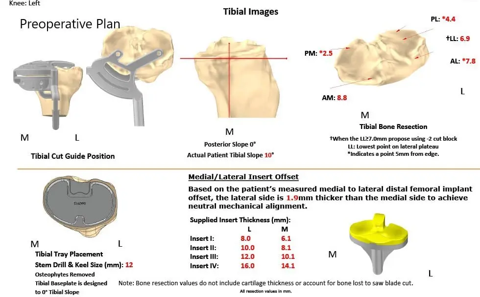 Complete Orthopedics patient specific surgical plan for a Customized Left Total Knee Replacement in a 73-year-old Male