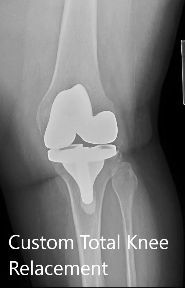 Postoperative X-ray showing the AP and lateral view of the left knee