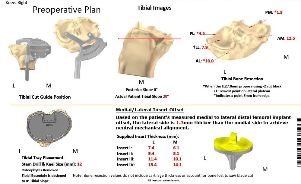 Complete Orthopedics patient specific surgical plan for a Customized Right Knee Replacement in a 72-year-old patient