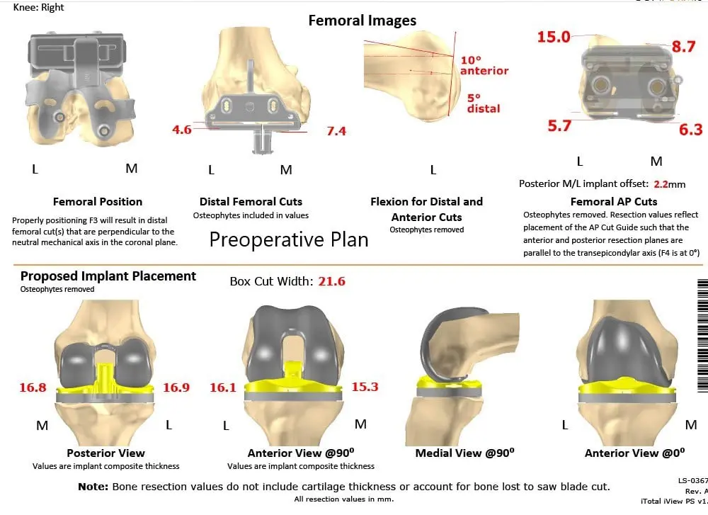 Complete Orthopedics patient specific surgical plan for a Customized Right Knee Replacement in a 72-year-old patient - scan 2