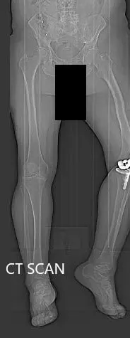 Preoperative topography CT scan images of the lower extremities