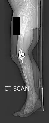 Preoperative topography CT scan images of the lower extremities - img 2