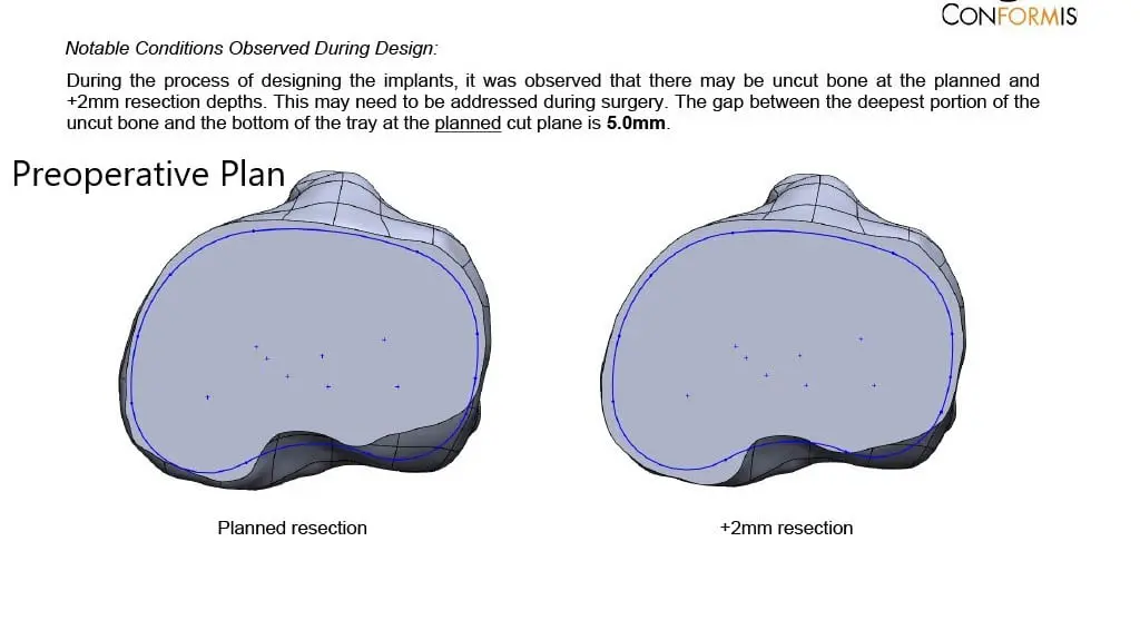 Complete Orthopedics patient specific surgical plan for a Customized Right Knee Replacement in a 65-year-old female - scan 3