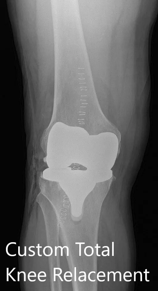 Postoperative X-ray showing AP and lateral views of the right knee