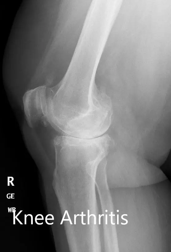 Preoperative X-ray of the right knee showing AP and lateral views - img 2