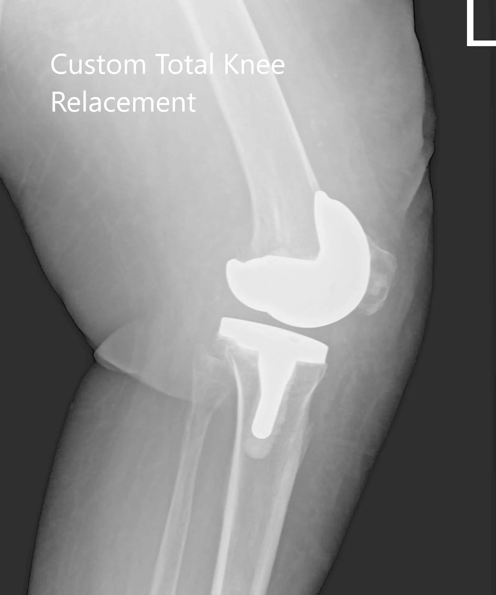 Postoperative X-ray showing AP and lateral images of the left knee - img 2