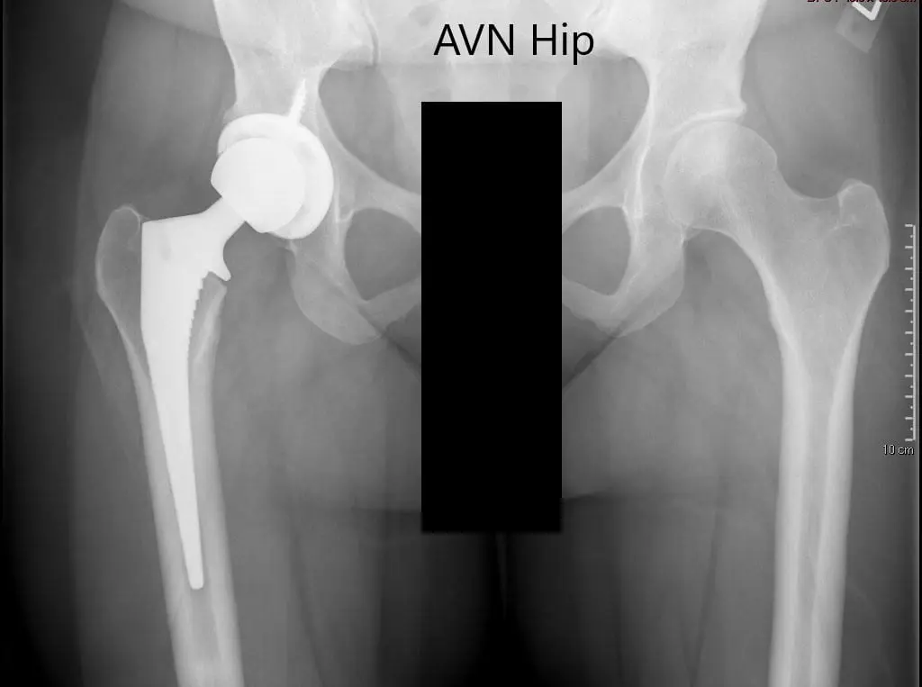 Preoperative X-ray of the pelvis with both hips showing intact artificial joint on the right side and AVN of the left hip