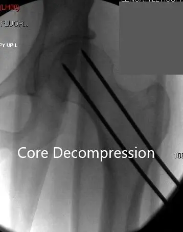 Anteroposterior view of the left hip showing pre-collapse avascular necrosis of the left hip