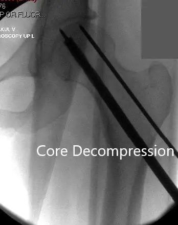 Core Decompression at the site of avascular necrosis