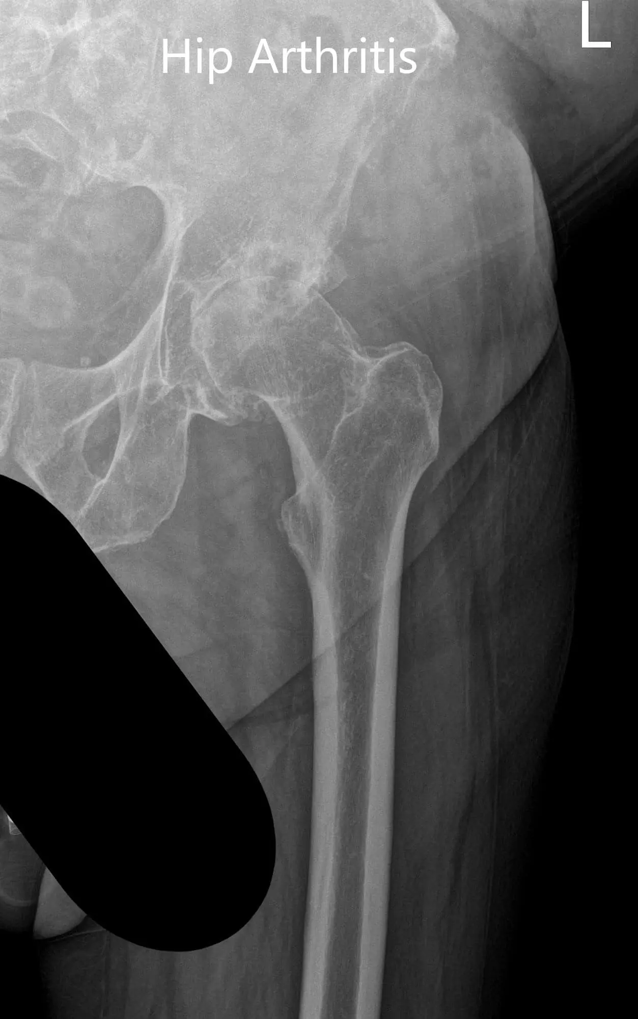 Preoperative X-ray showing the frog-legged lateral and AP view of the left hip - img 2