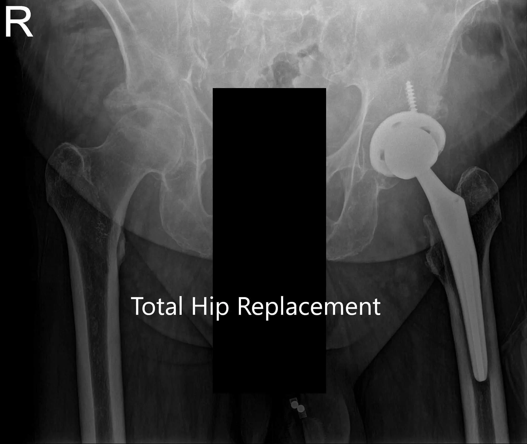 Postoperative X-ray of the Pelvis and lateral view of the left hip