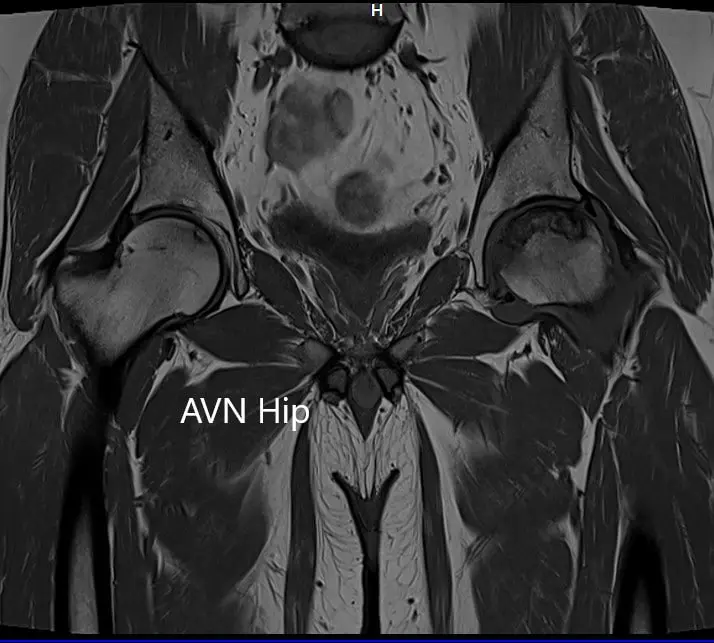 T1WI coronal section of MRI showing AVN hip