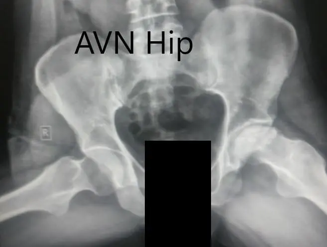 Frog-legged lateral view of both the hip joints