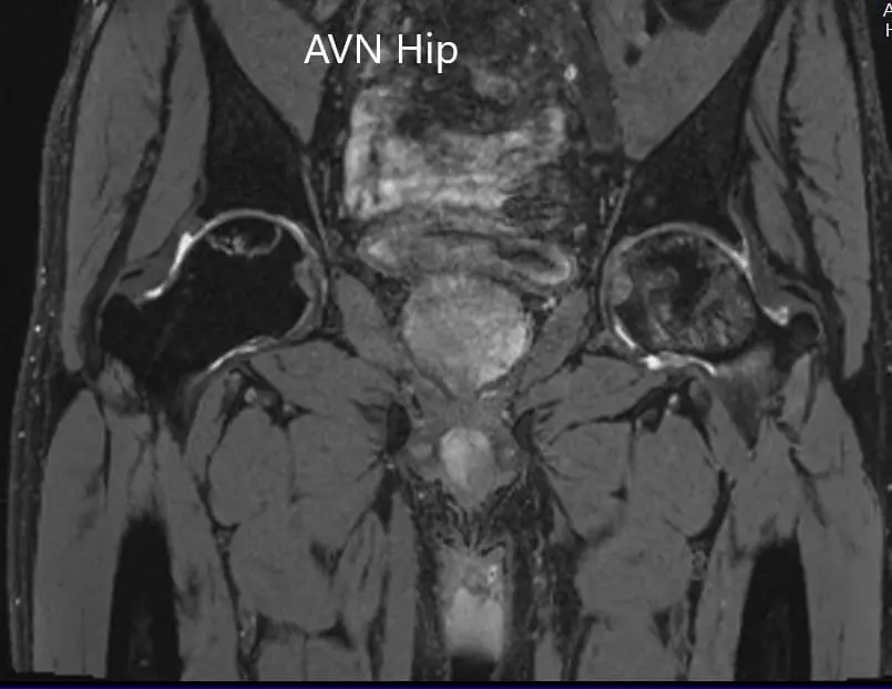 T2WI coronal section of MRI showing AVN hip