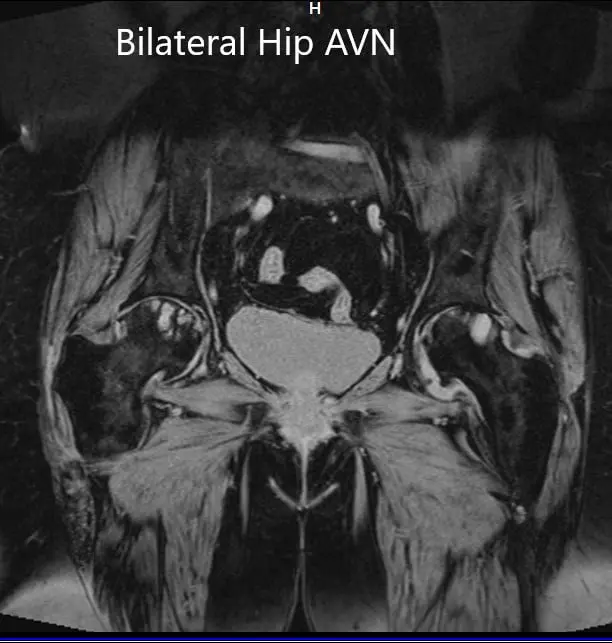Coronal section of T1WI of pelvis MRI