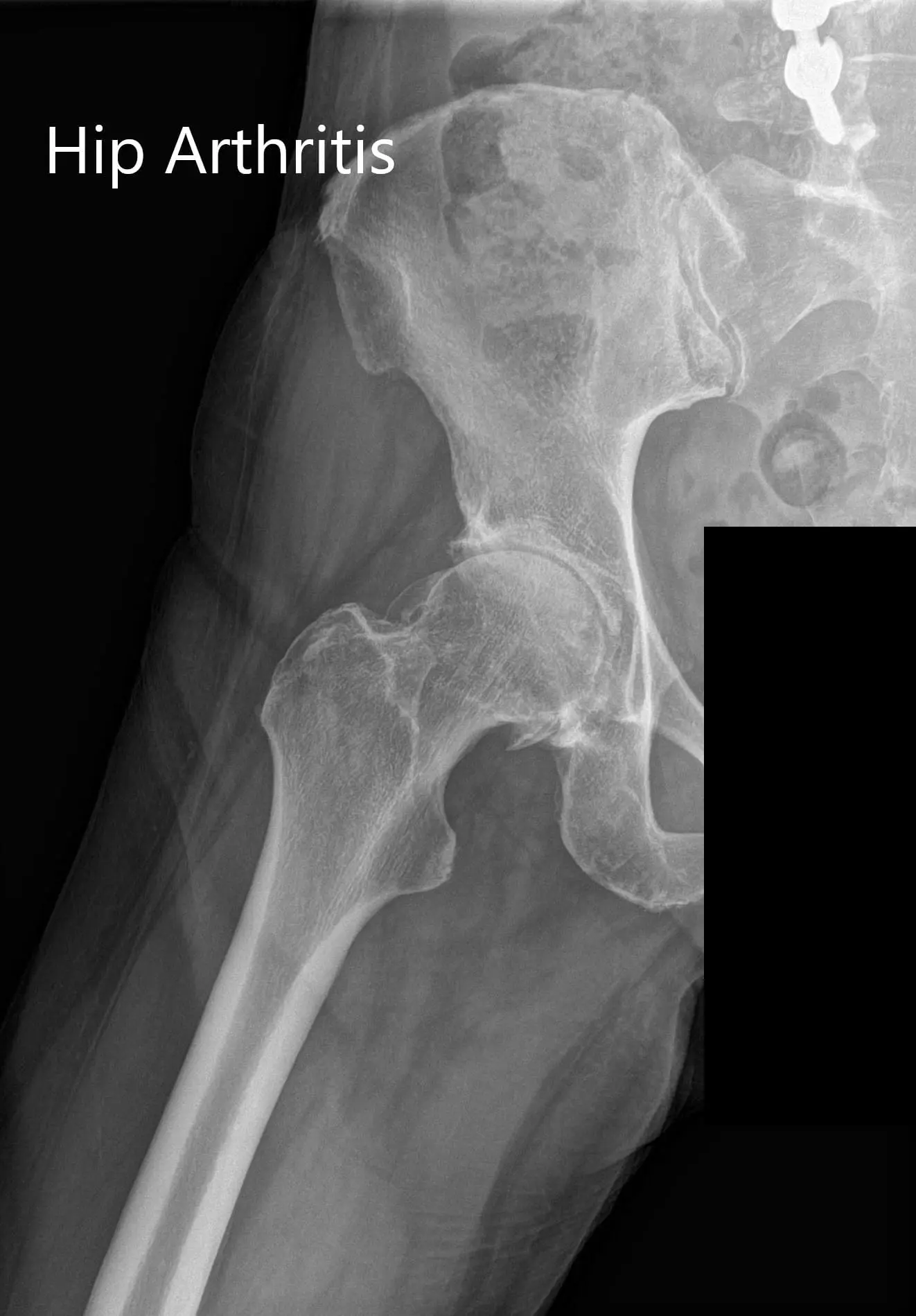 Preoperative X-ray Showing the AP and lateral views of the right hip - img 2 Preoperative X-ray Showing the AP and lateral views of the right hip - img 2
