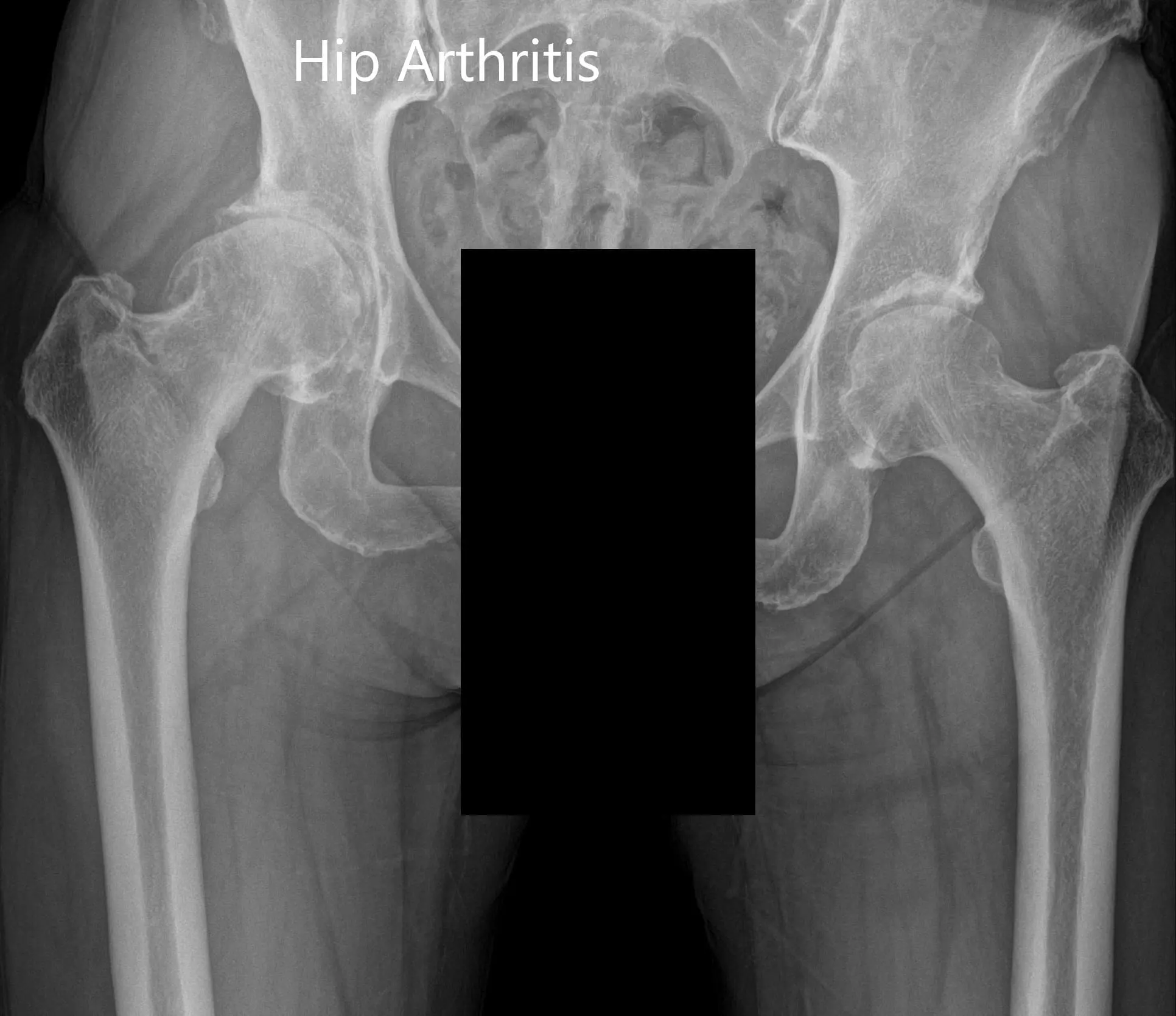 Preoperative X-ray showing the AP view of the pelvis with both hips Preoperative X-ray showing the AP view of the pelvis with both hips