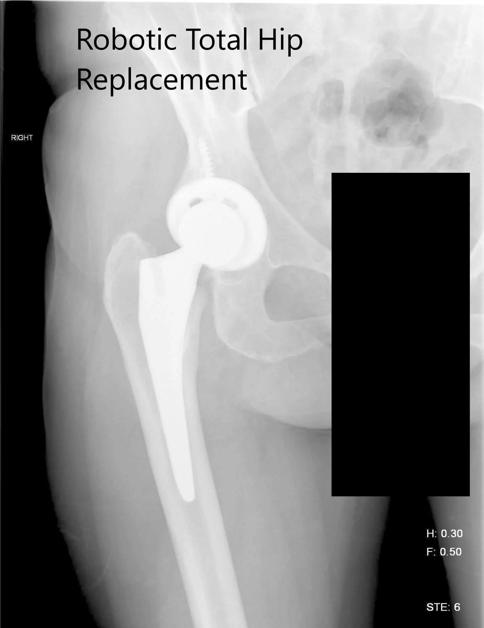 Postoperative X-ray of the right hip showing AP and lateral view Postoperative X-ray of the right hip showing AP and lateral view