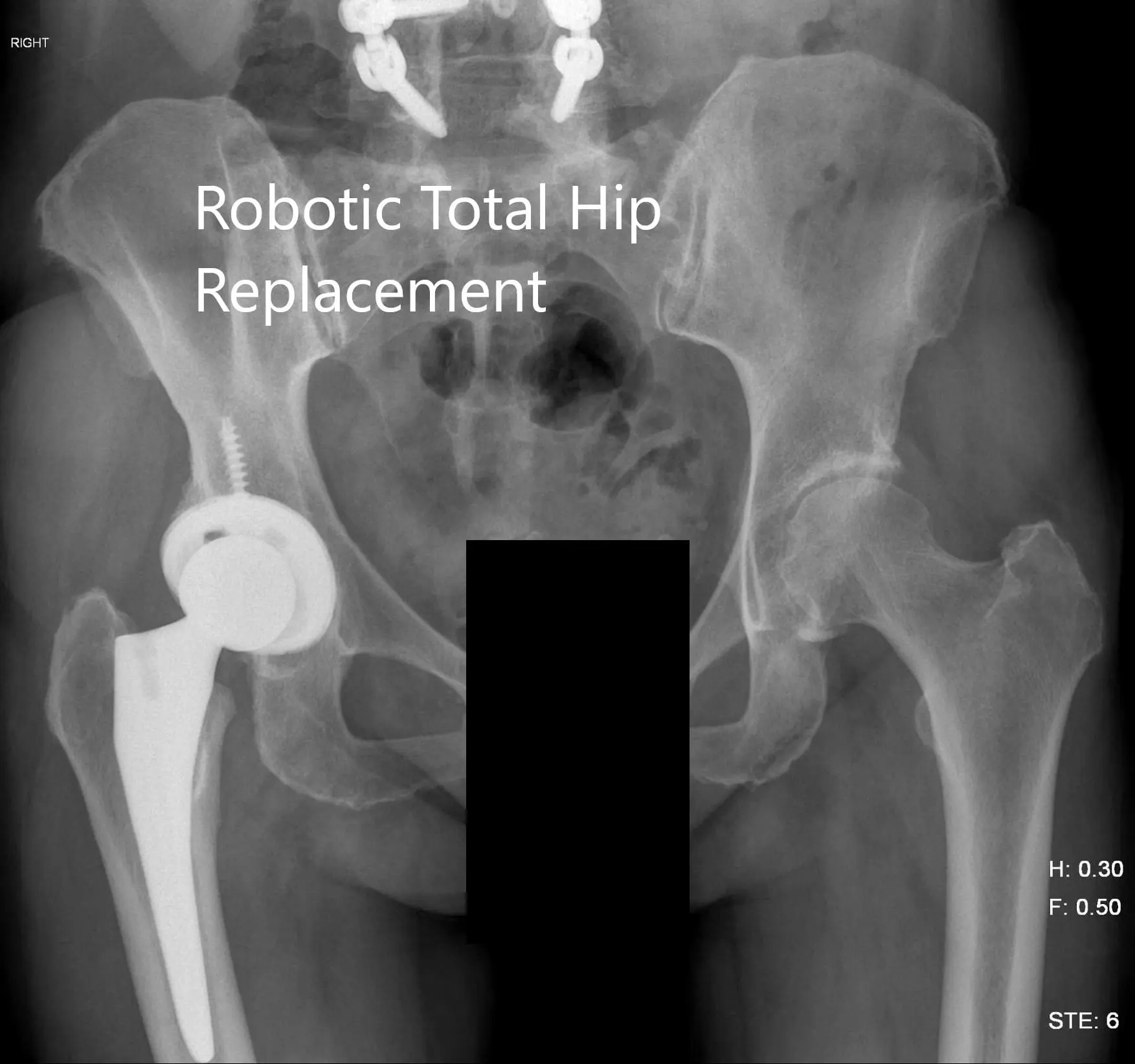 Postoperative X-ray of the pelvis showing AP view Postoperative X-ray of the pelvis showing AP view