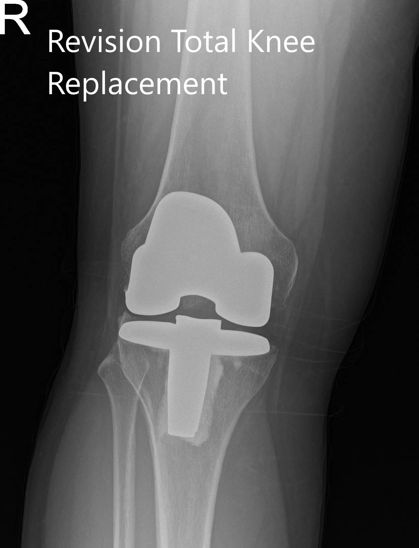 Postoperative x-ray showing the anteroposterior and lateral views of the right knee