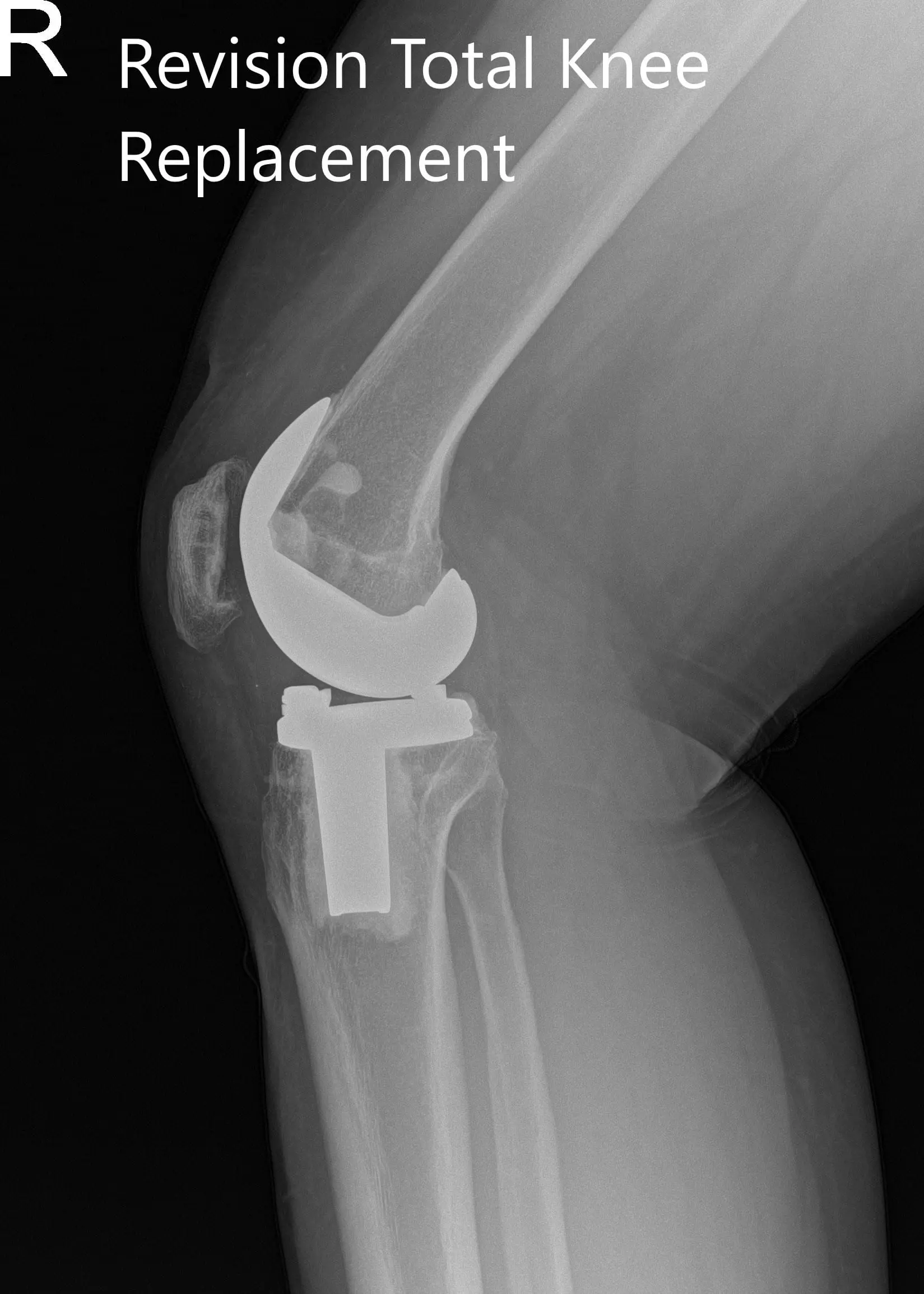 Postoperative x-ray showing the anteroposterior and lateral views of the right knee - img 2