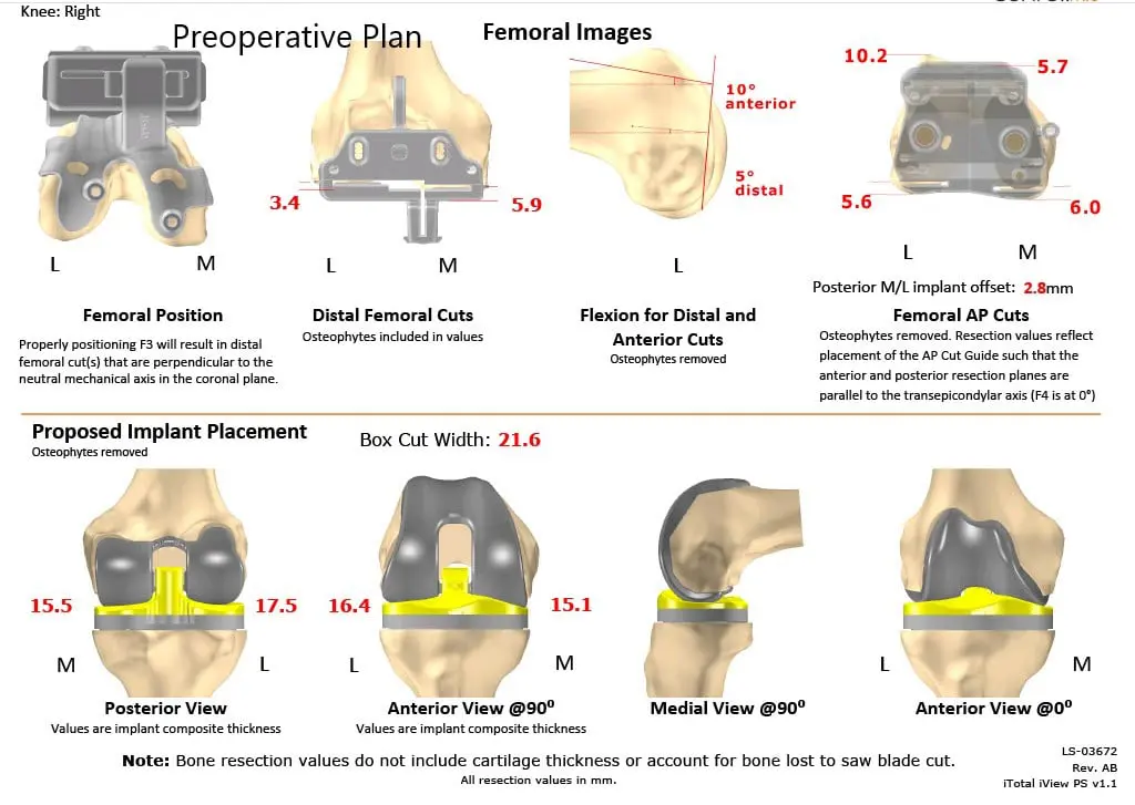 Complete Orthopedics patient specific surgical plan for a Right Custom Knee Replacement in a 59-year-old male - scan 2