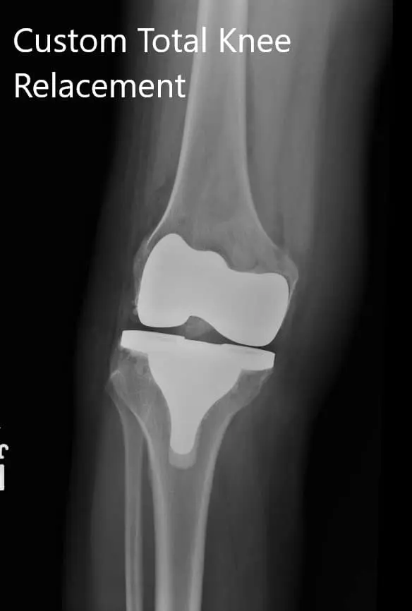 Postoperative images showing AP and oblique views of the right knee