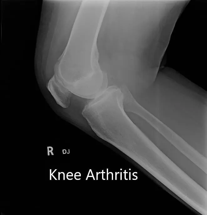 Preoperative X-ray showing AP and lateral view of the right knee joint, and skyline view of both the knee joints - img 2