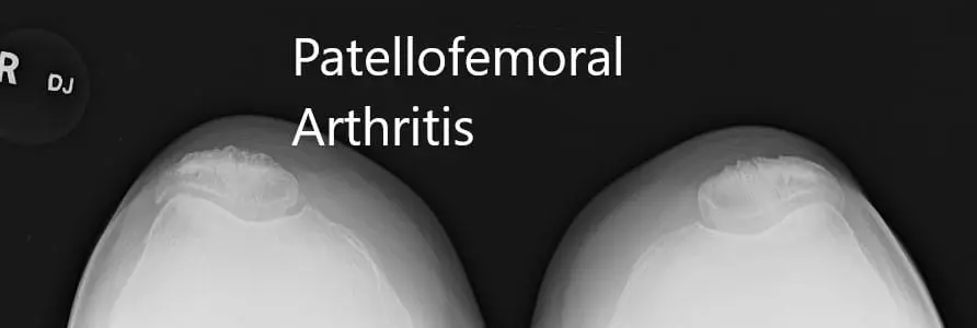 Preoperative X-ray showing AP and lateral view of the right knee joint, and skyline view of both the knee joints - img 3