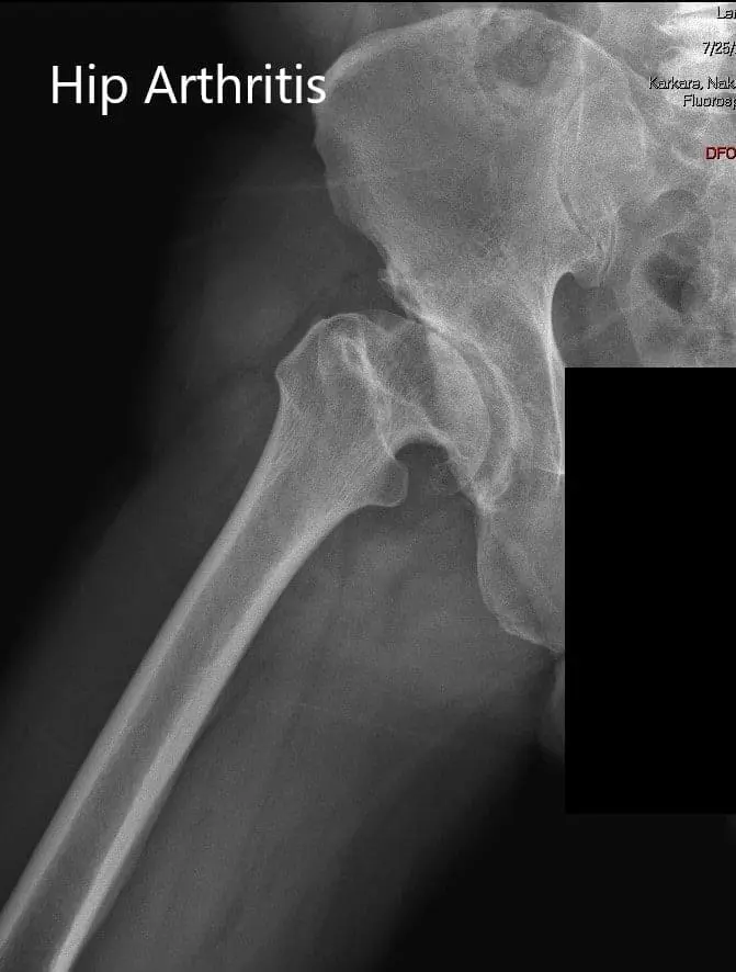 AP and lateral views of the right hip joint - img 2