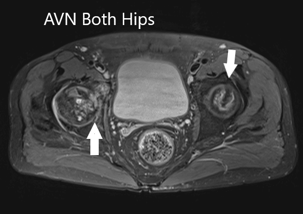Axial section T1WI showing bilateral AVN of the femoral heads