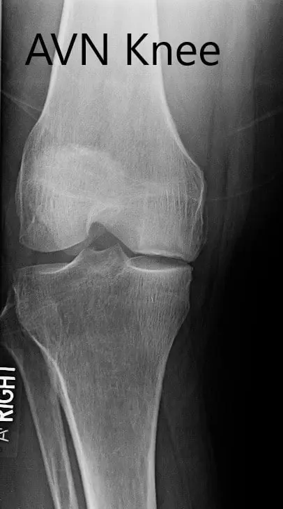 Preoperative X-ray of the right knee in anteroposterior and lateral views
