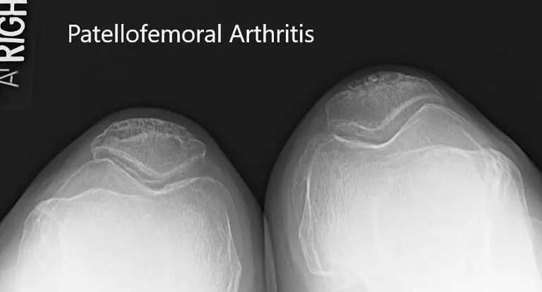 Preoperative x-ray showing the merchant view of both the knees
