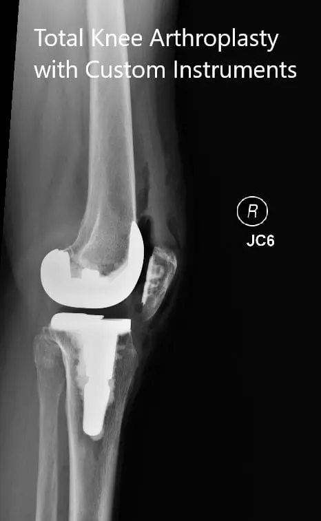 Postoperative x-rays showing the anteroposterior and lateral views of the right knee - img 2