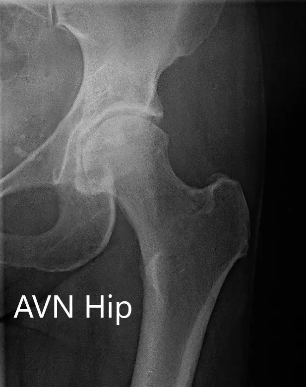 X-ray showing the AP and frog-legged lateral views of the left hip joint