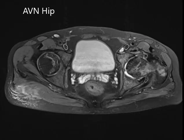 Axial section of the T2WI of the pelvis