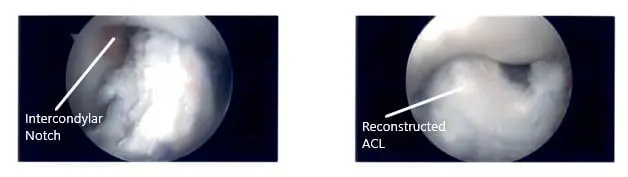 Intraoperative Arthroscopic Images of the left knee 3