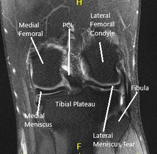 MRI of the Knee in coronal and sagittal sections