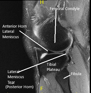 MRI of the Knee in coronal and sagittal sections 2