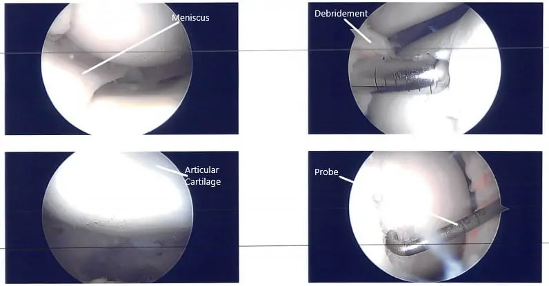 Intraoperative arthroscopic images 2